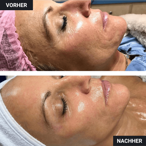 Vorher Nachher Gesicht seitlich Botox