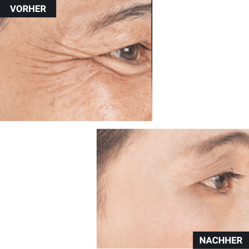 Vorher Nachher Krähenfüße Botox
