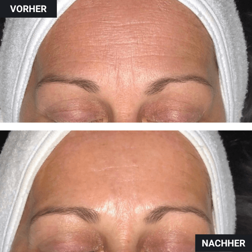 Vorher Nachher Stirn frontal Botox