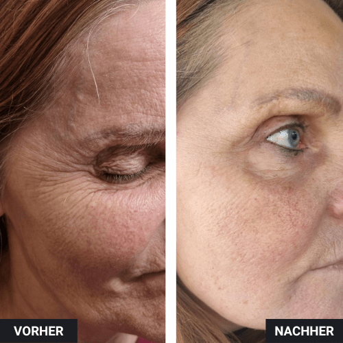 Vorher Nachher Stirn Krähenfüße Botox