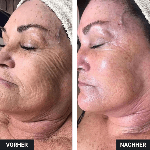 Vorher Nachher Vollgesicht Botox