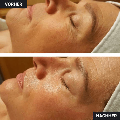 Vorher Nachher Wange Botox
